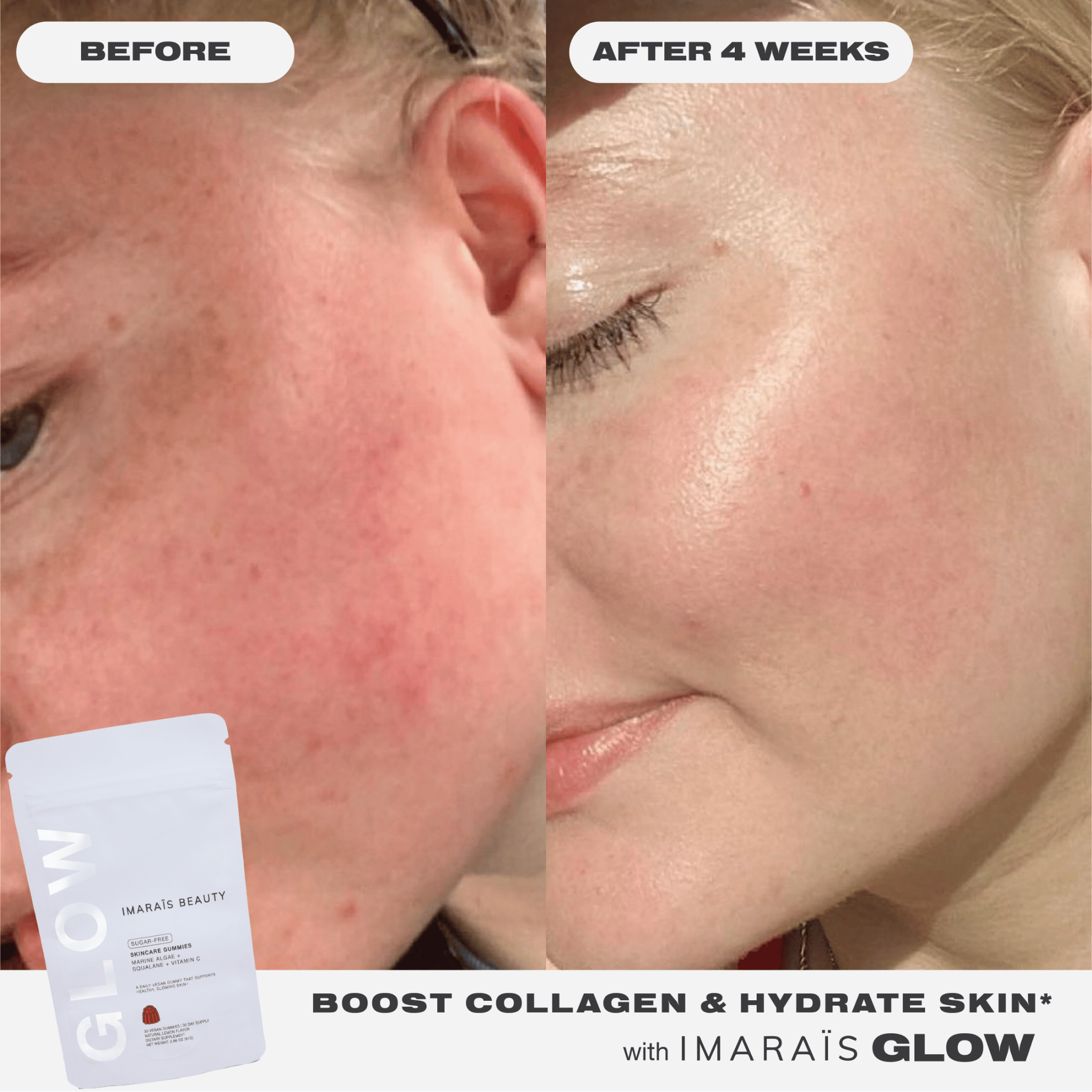 Side-by-side comparison of a woman's cheek before and after 4 weeks of using Imarais Glow skincare gummies, showing visibly smoother, more hydrated skin. Text reads: 'Boost Collagen & Hydrate Skin* with Imarais Glow.' Product pouch shown in the corner.